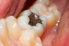 Amalgam filling Amalgam filling