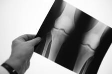 bone-xray bone-xray