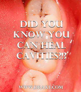 heal-cavities-naturally-dr-axe