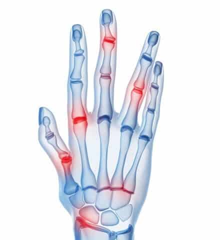 skeletal hands arthritis