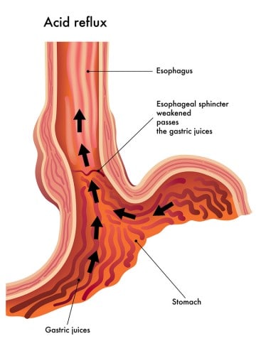 Acid Reflux