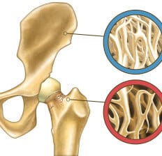 Skeleton close-up showing normal bone and osteoporosis. Digital