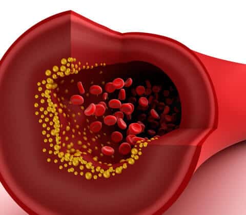 Closeup view of cholesterol in blood vessel