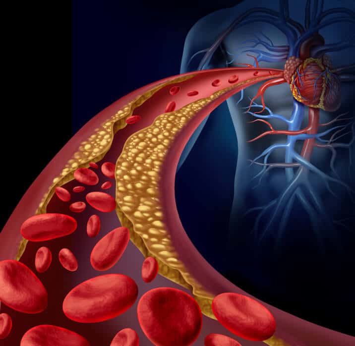 Atheroma Formation With Hypercholesterolemia Diet