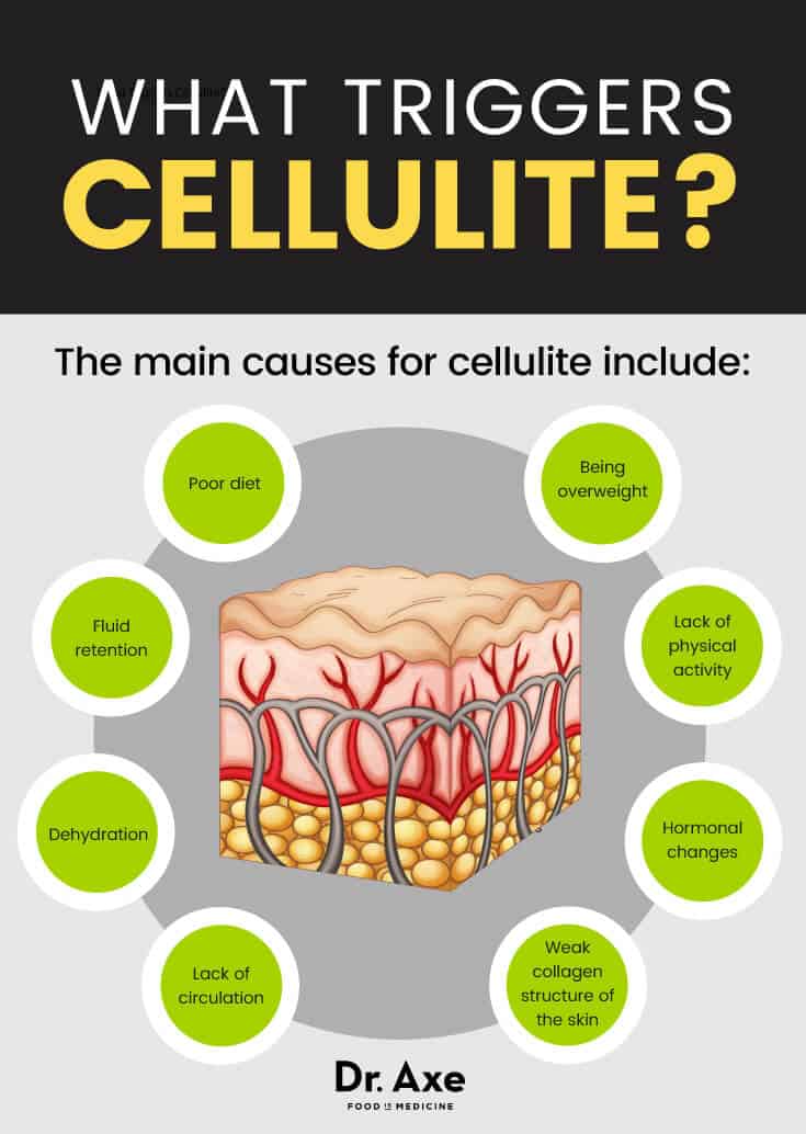 What triggers cellulite - Dr. Axe