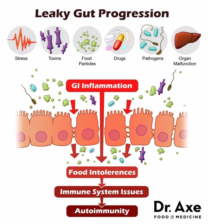 Leaky Gut Diagrams - Nutrition Advancement