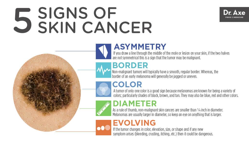 Skin Cancer Signs And Symptoms