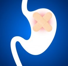 Gastritis, Stomach Ulcers improvement
