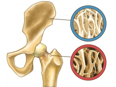 healthy and unhealthy bone density anatomy