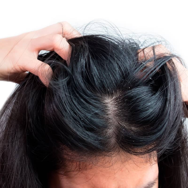How to Get Rid of Dandruff: 10 Natural Remedies - Dr. Axe