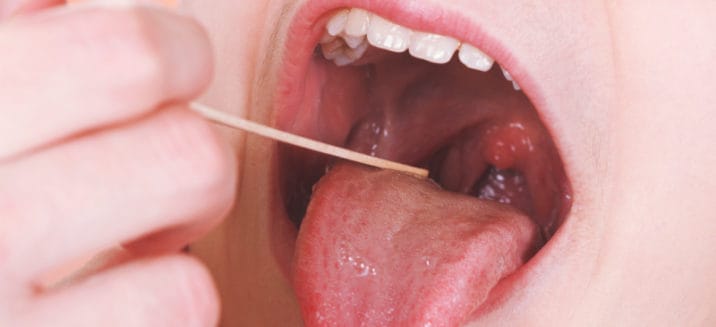 tonsillitis-4-ways-to-help-get-rid-of-tonsillitis-symptoms-dr-axe