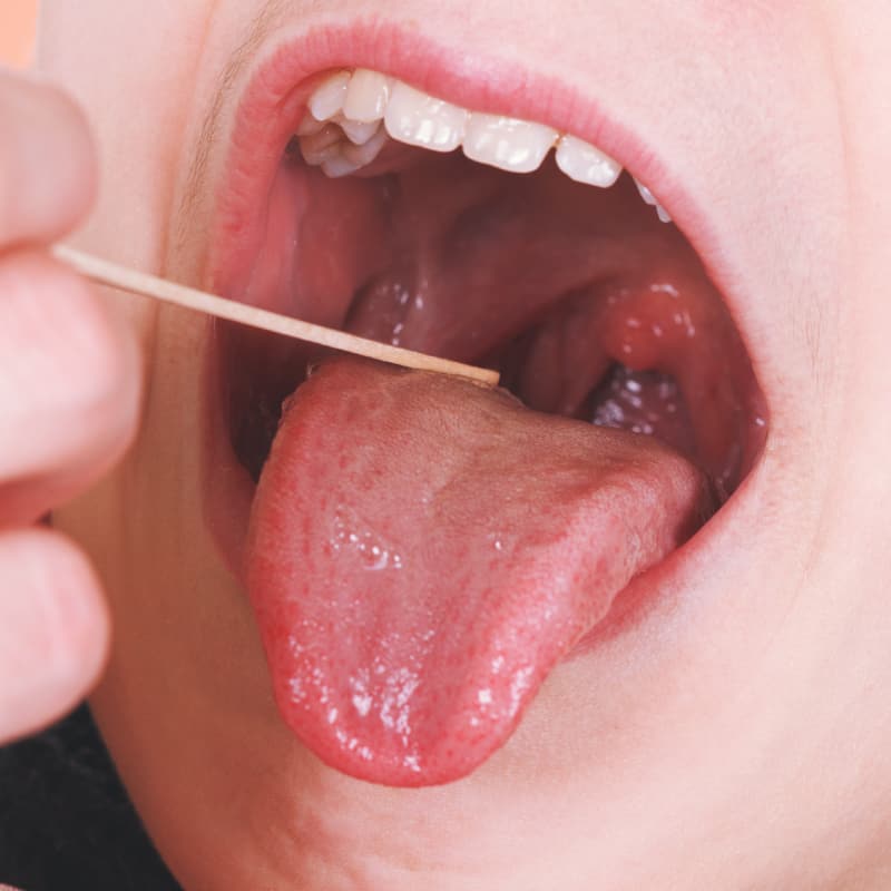 how to treat tonsillitis without antibiotics