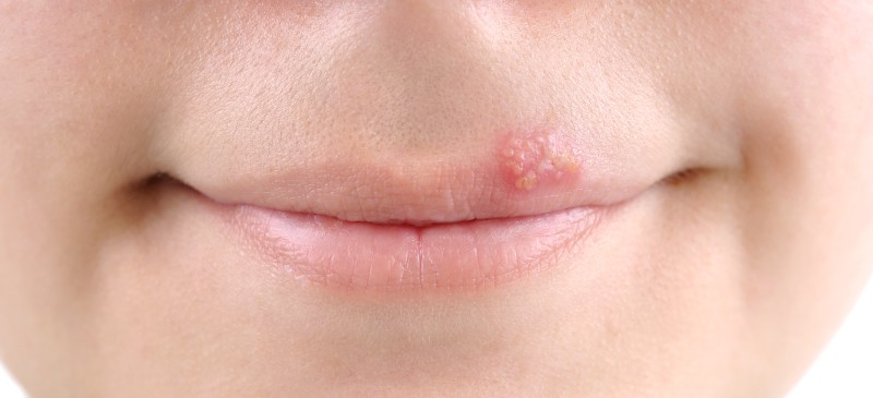 Cold sore online in cheek