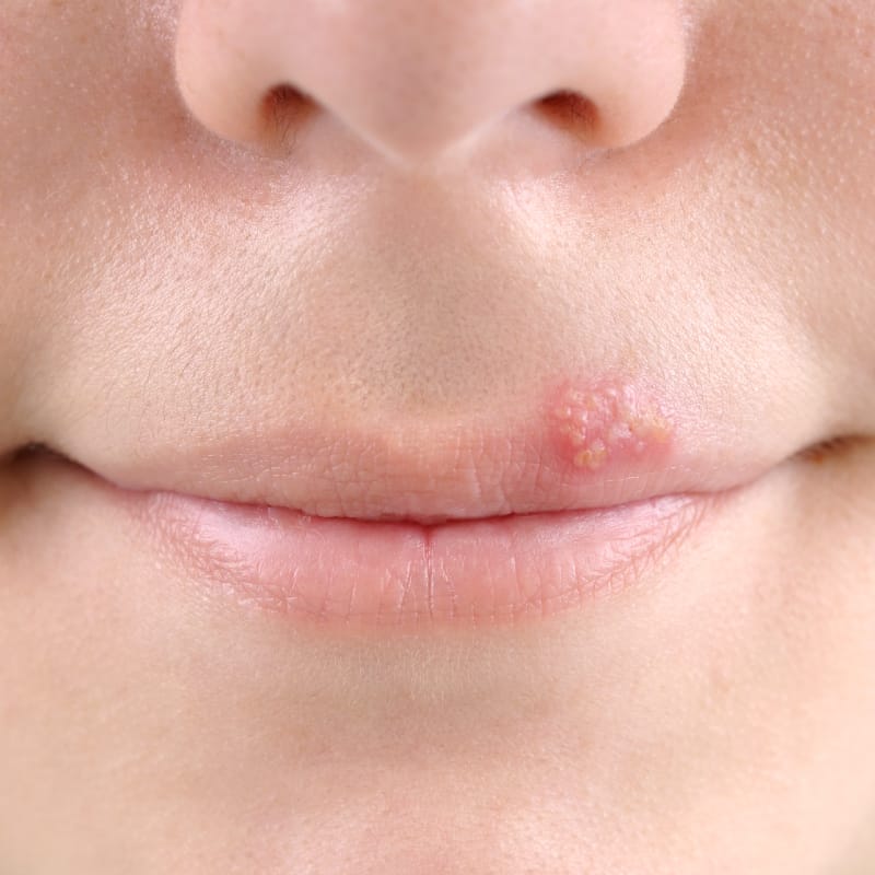 herpes on cheek of face