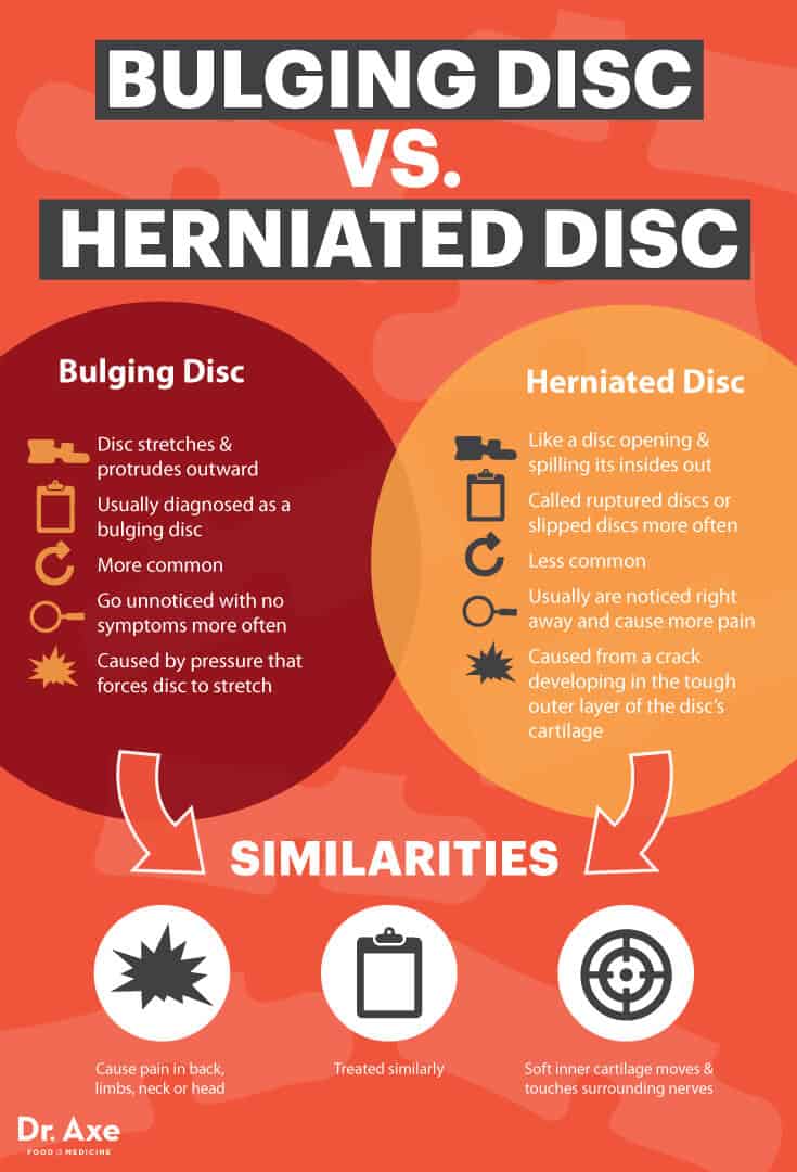 Bulging disc vs. herniated disc - Dr. Axe