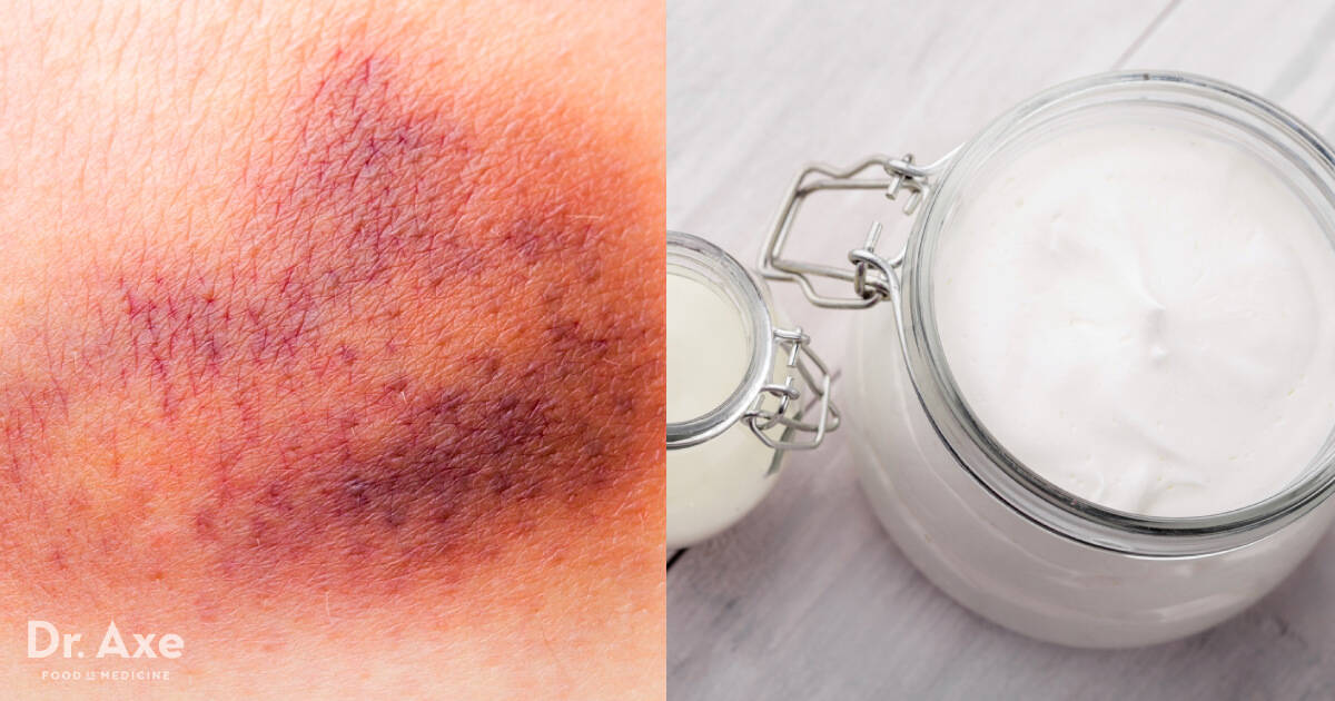 Bruise Cream with Arnica & Bilberry Dr. Axe