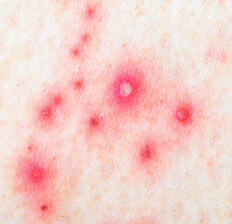 Is shingles contagious for adults?