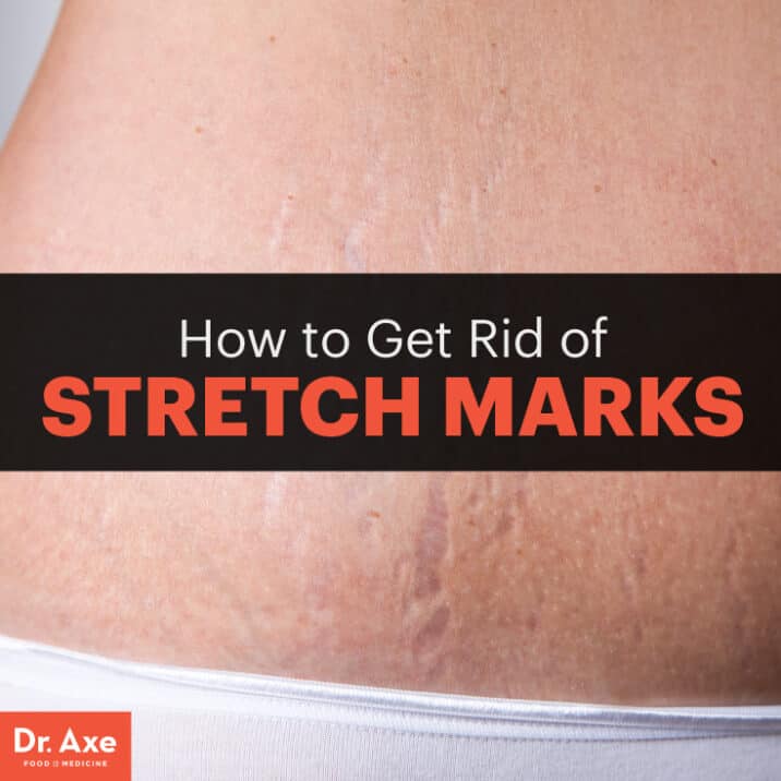 How to Get Rid of Stretch Marks - Dr. Axe