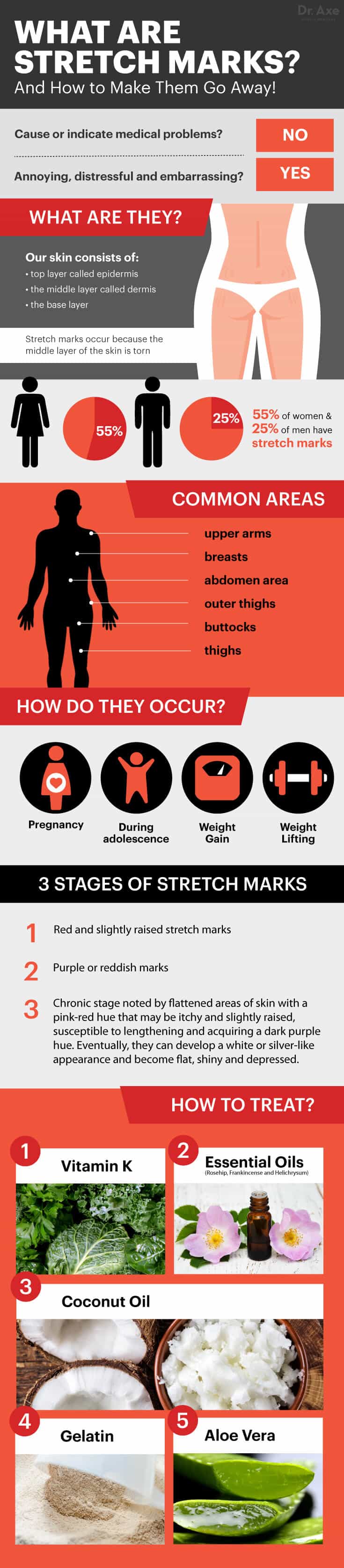 How to Get Rid of Stretch Marks - Dr. Axe