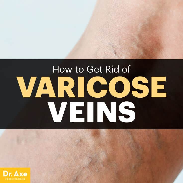 How to Get Rid of Varicose Veins: 5 Natural Remedies - Dr. Axe