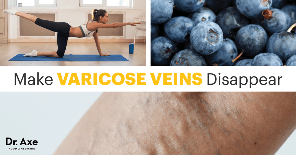 How to Get Rid of Varicose Veins: 5 Natural Remedies - Dr. Axe