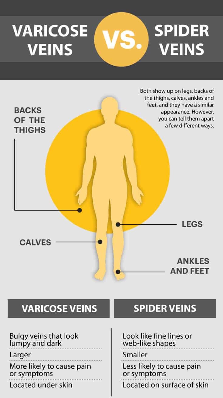 Varicose veins vs. spider veins