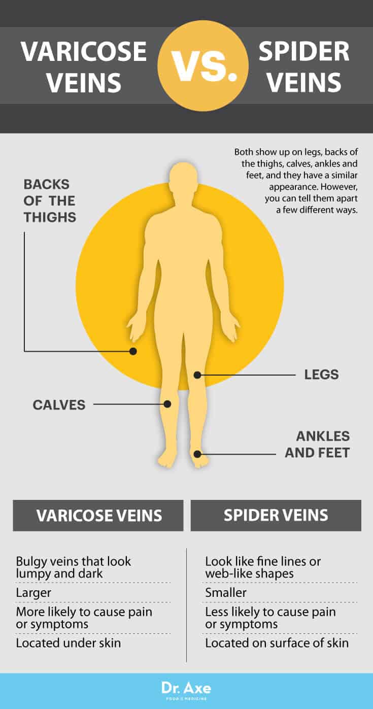 How to Get Rid of Varicose Veins: 5 Natural Remedies - Dr. Axe