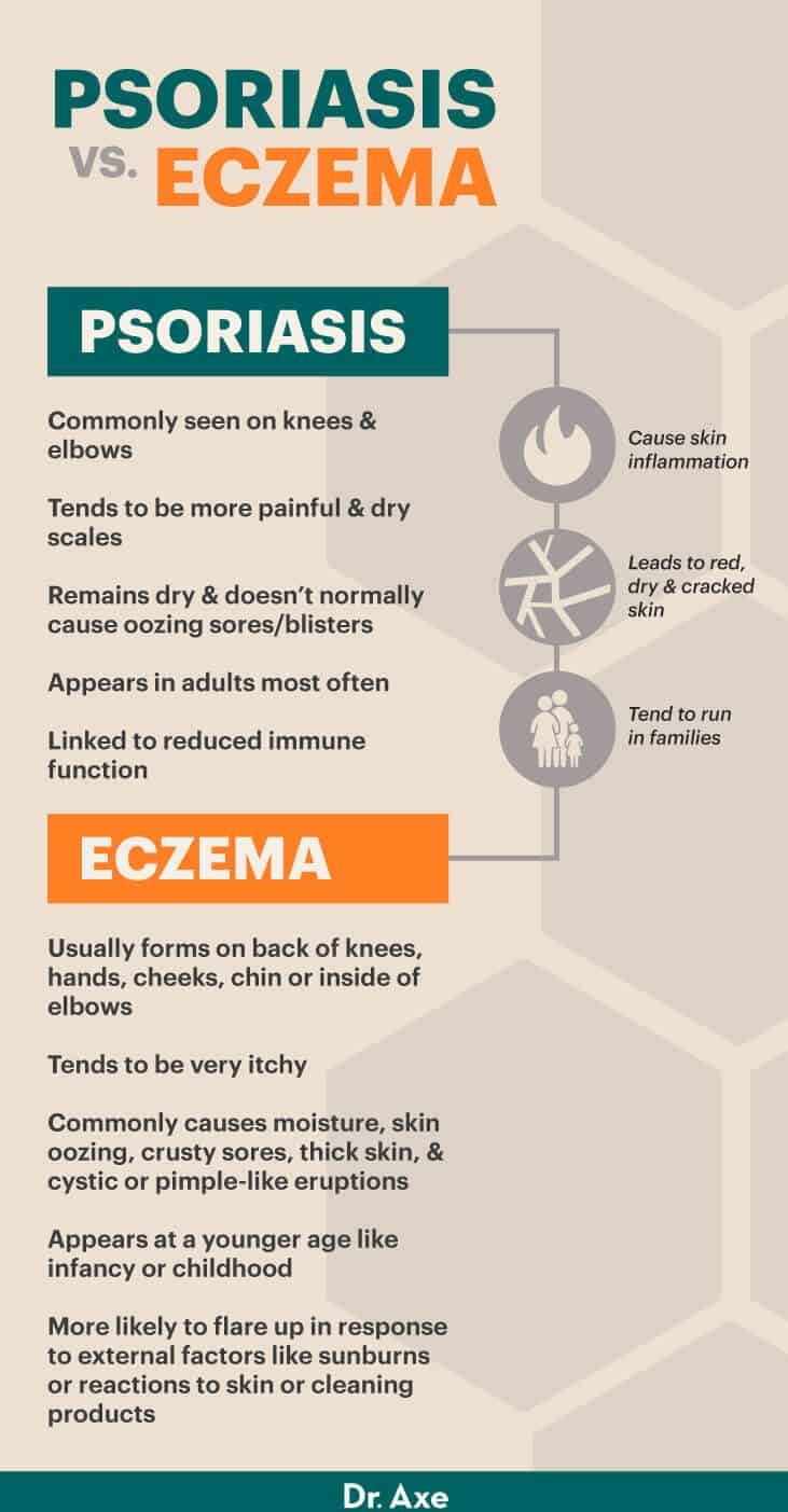 Psoriasis vs. eczema - Dr. Axe
