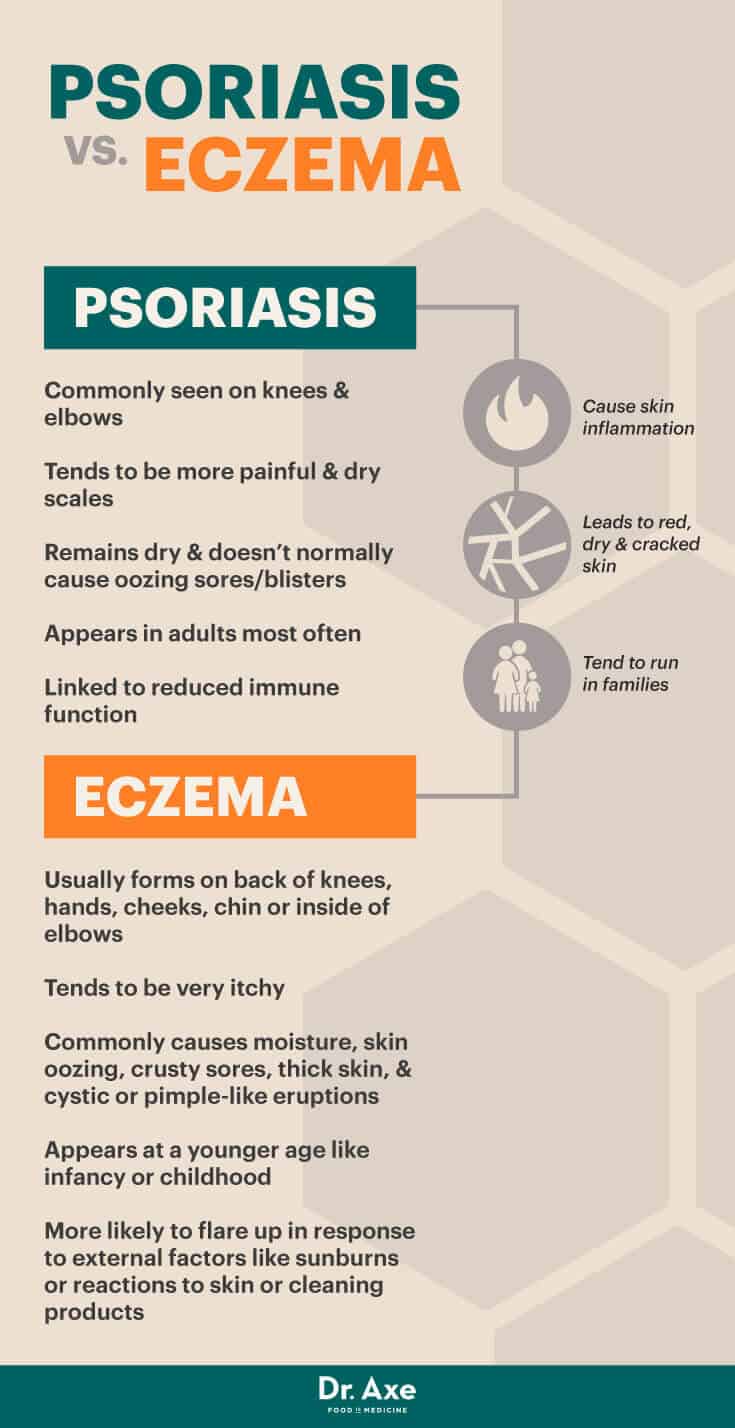 Psoriasis vs. eczema - Dr. Axe