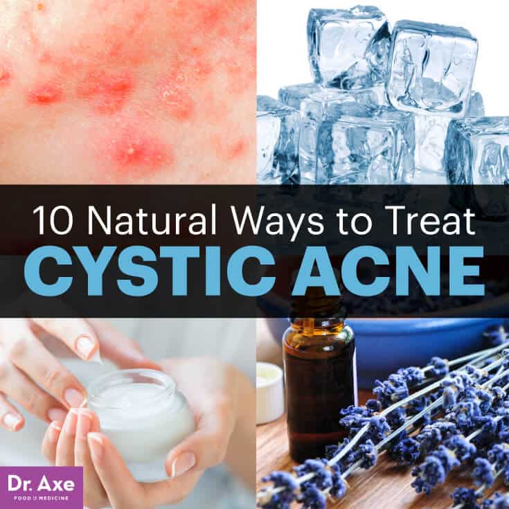 cystic treatments acne deep Adult