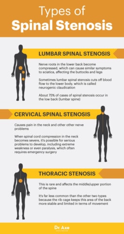 Spinal Stenosis Symptoms, Causes & Treatments - Dr. Axe