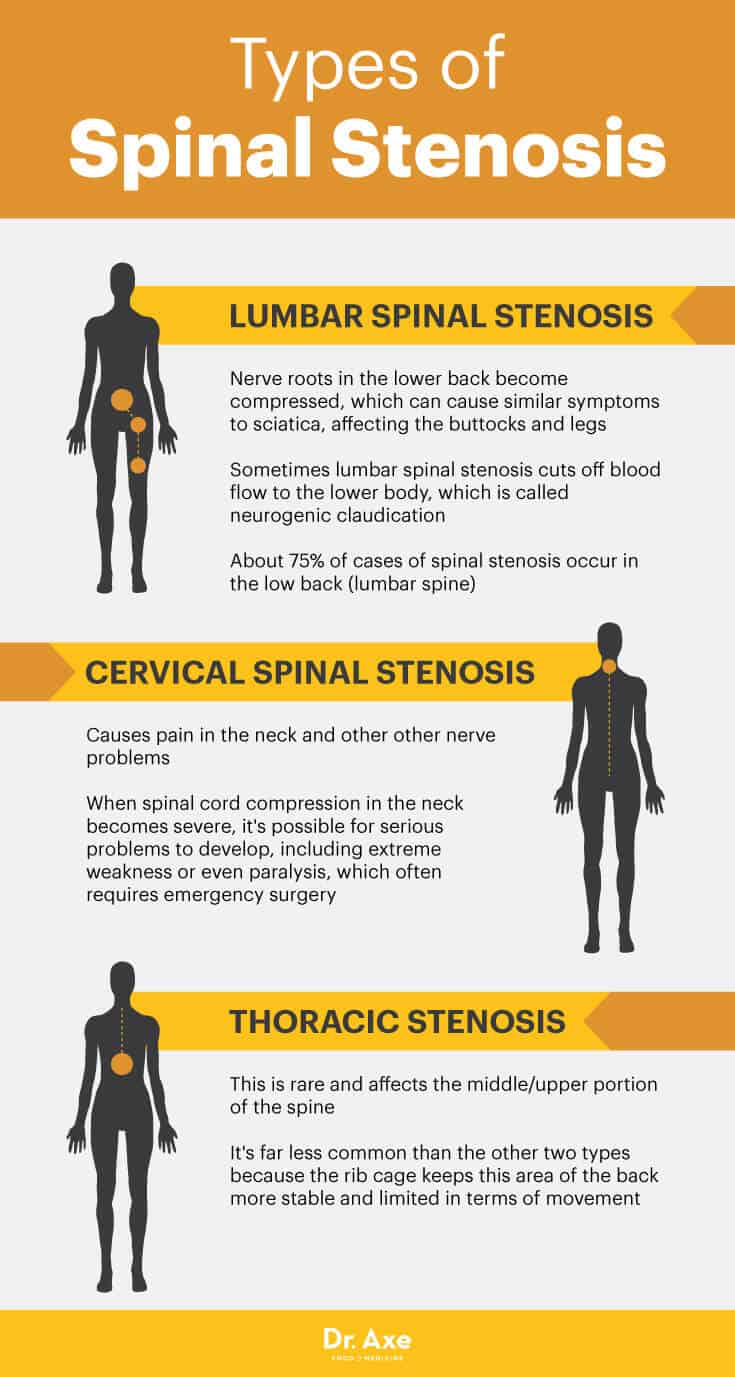 Types of spinal stenosis - Dr. Axe