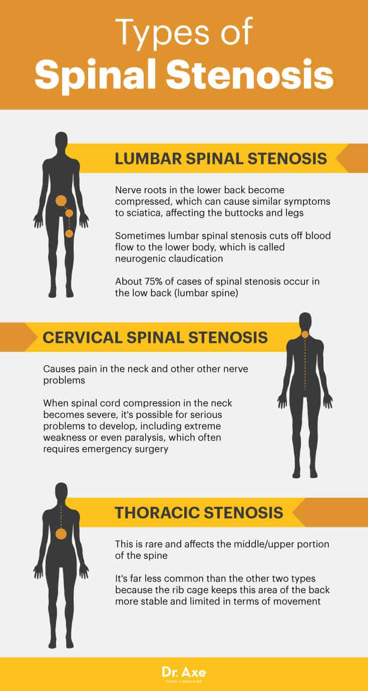 Spinal Stenosis Causes Symptoms Diagnosis And Management 54 OFF