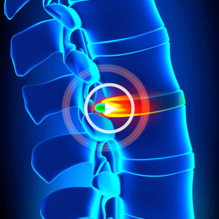 How To Heal A Herniated Disc Naturally - Cellaxys