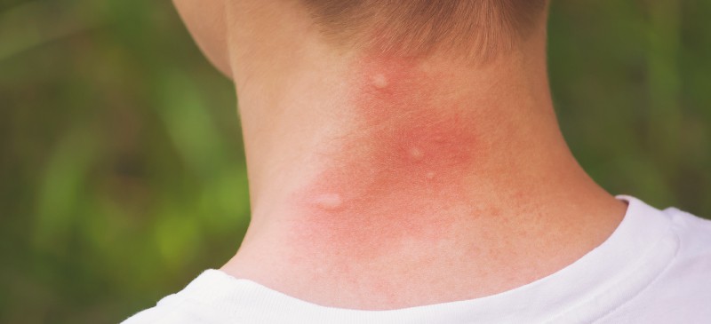 Mosquito Bites on the Skin Under the Breast Stock Image - Image of