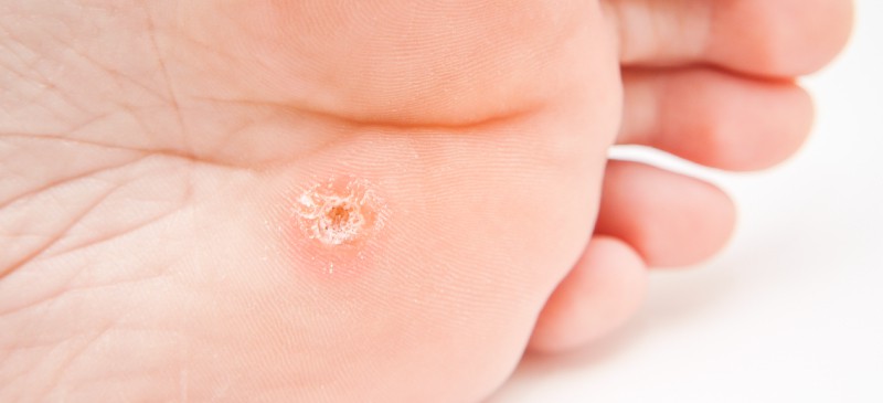 How to get rid of warts - Dr. Axe