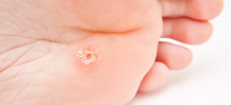 How To Get Rid Of Warts Naturally Wart Symptoms Causes Dr Axe