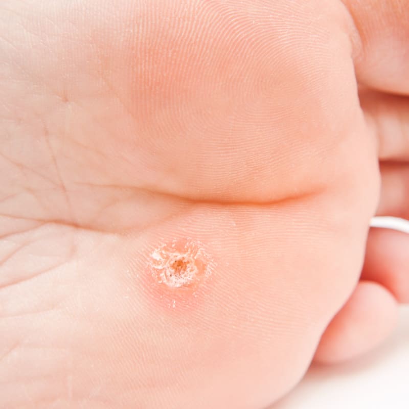 How to Get Rid of Warts Naturally + Wart Symptoms, Causes - Dr. Axe