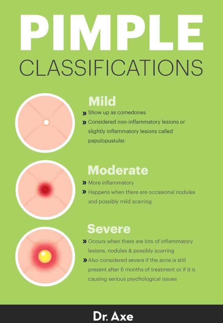 Pimple classifications - Dr. Axe