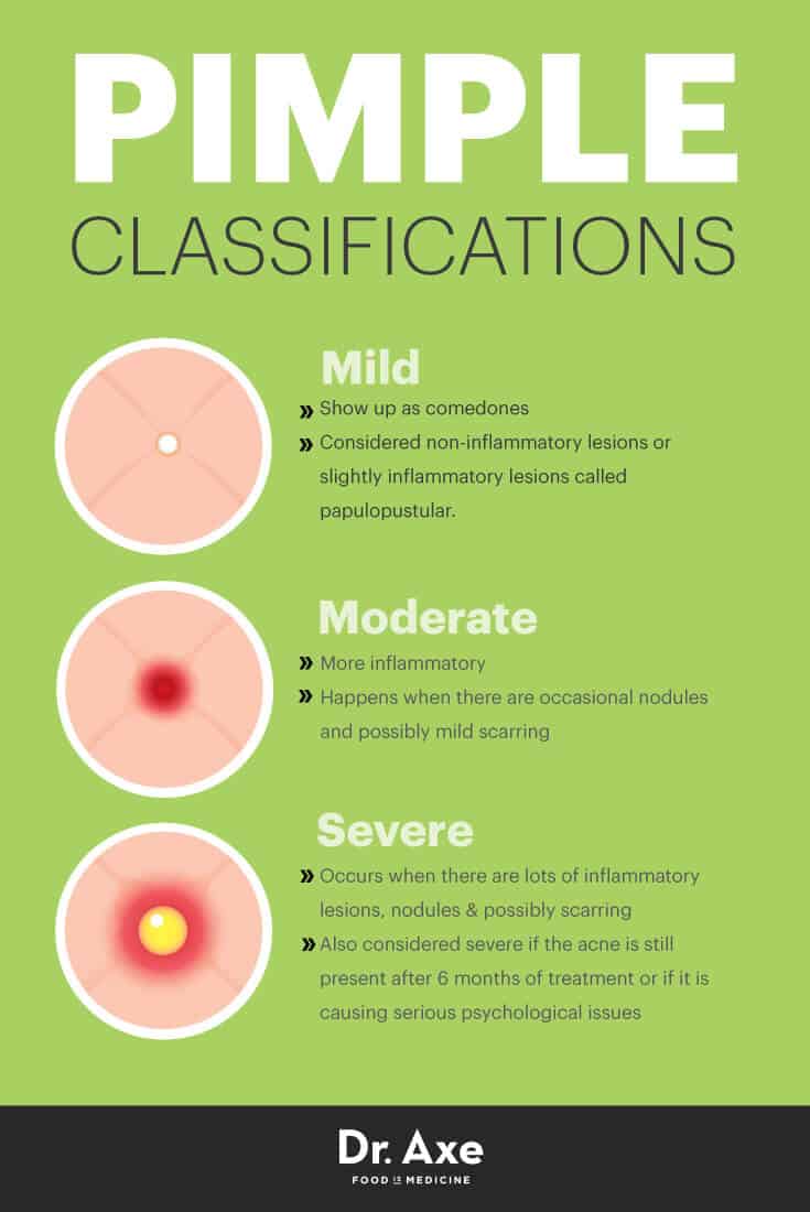 Pimple classifications - Dr. Axe