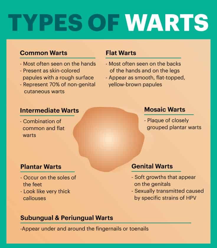Types of warts - Dr. Axe