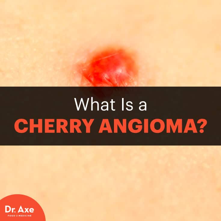 Cherry angioma - Dr. Axe