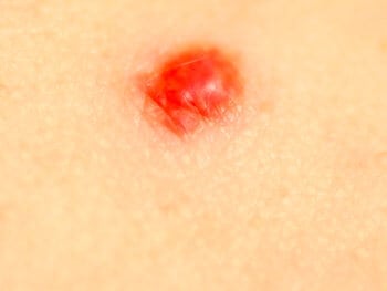 Cherry angioma - Dr. Axe