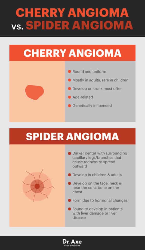 Cherry Angioma Risk Factors Symptoms And Natural Treatments Dr Axe 