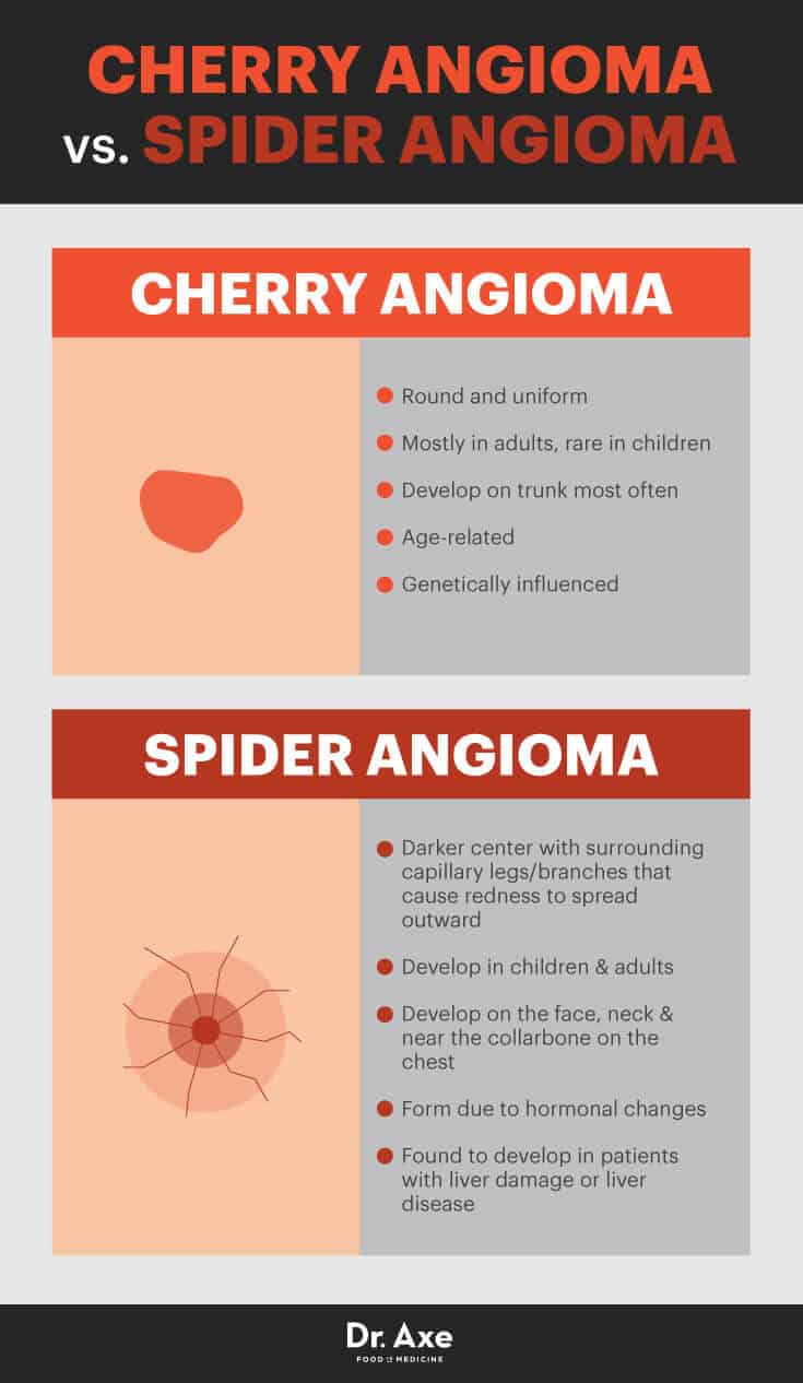 Cherry angioma vs. spider angioma - Dr. Axe