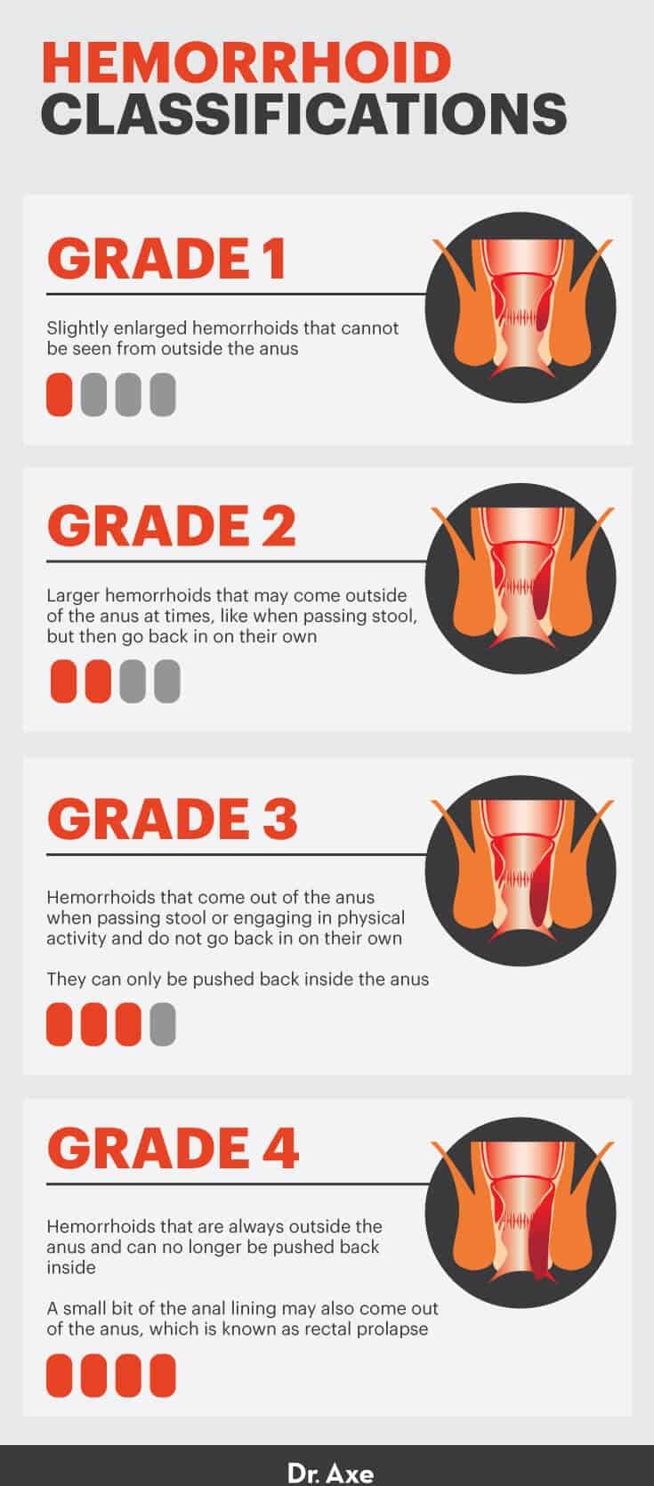 external hemorrhoid stages