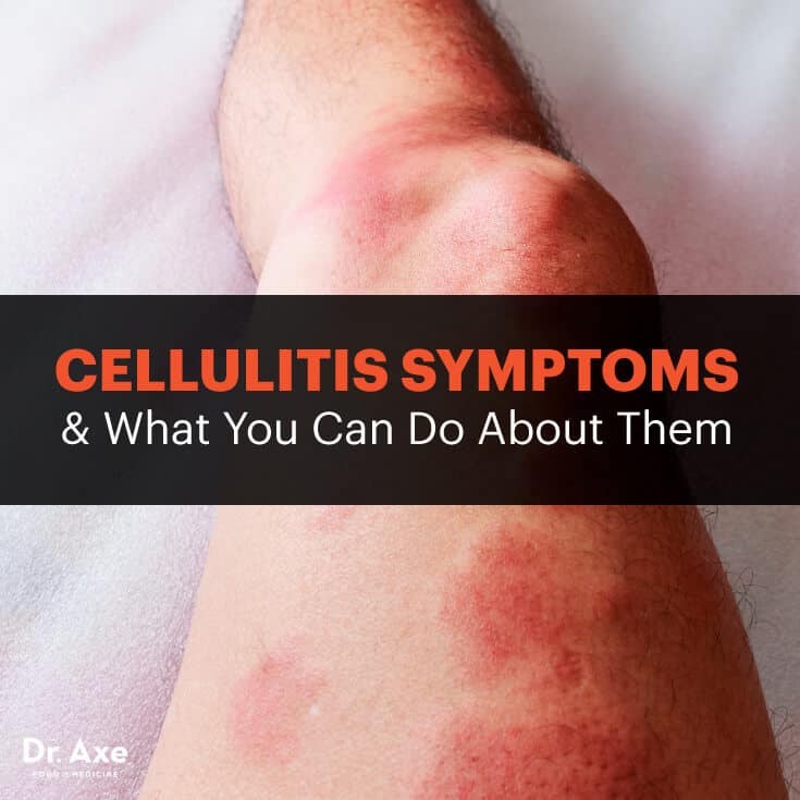 Cellulitis symptoms - Dr. Axe