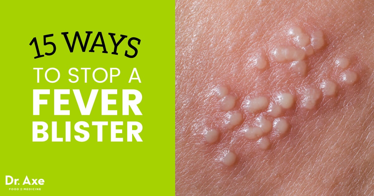 How to cure fever blisters