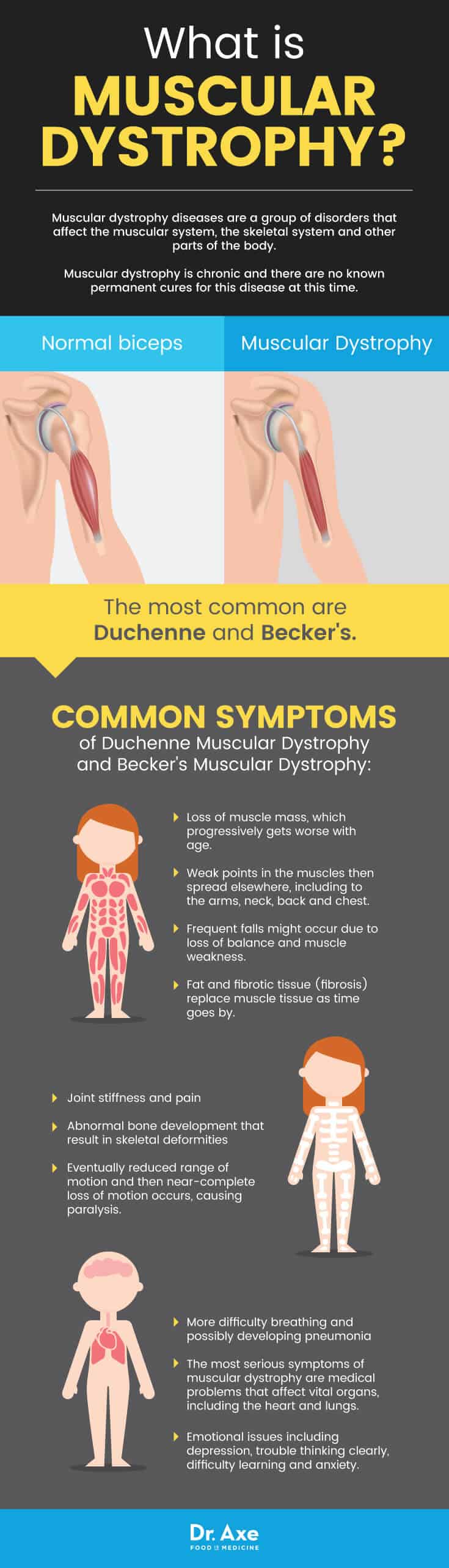 Muscular dystrophy symptoms