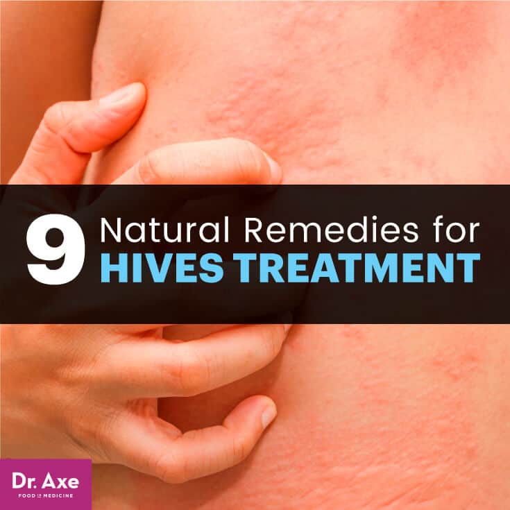 Allergic reaction rash natural treatment